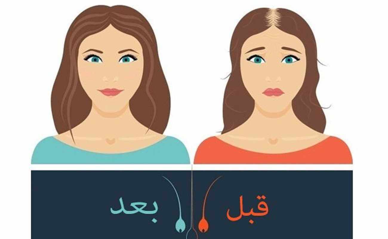 قبل وبعد زراعة الشعر اكثر من 10 نصائح تقدم قبل و بعد عمليات زرع