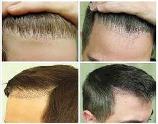 Можно ли уменьшить лоб с помощью пересадки волос