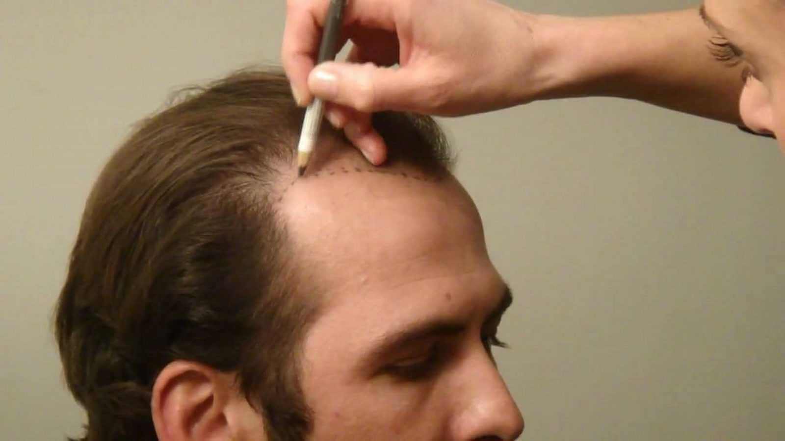 الفرق بين تقنية DHI وFUE في عمليات زراعة الشعر