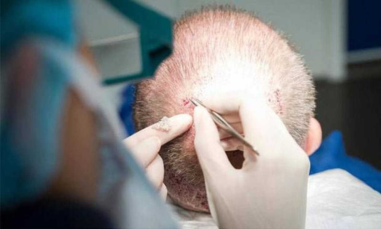 الفرق بين زراعة الشعر بتقنية DHI وتقنية FUE