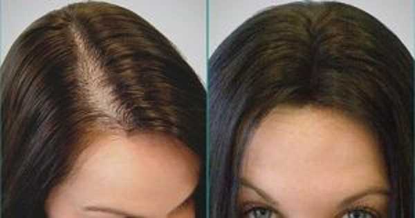 زراعة الشعر النساء