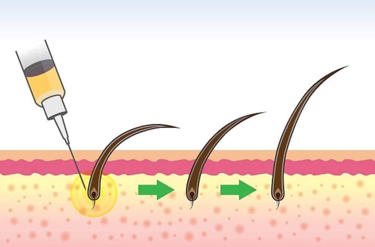 تقنية الخلايا الجذعية في زراعة الشعر