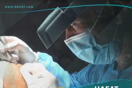 اضرار زراعة الشعر