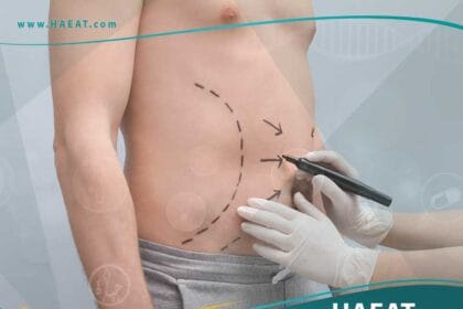 شفط الدهون من البطن