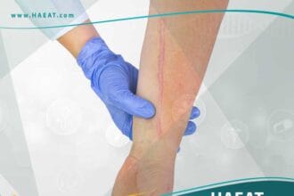 عمليات تجميل الجروح