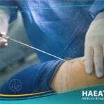 سلبيات شفط الدهون