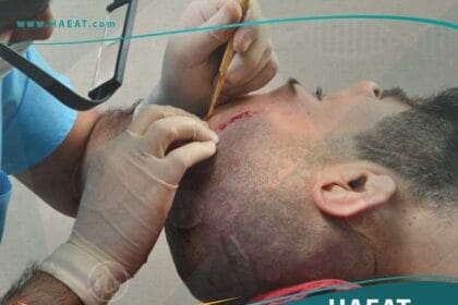 عمليات تجميل الشعر