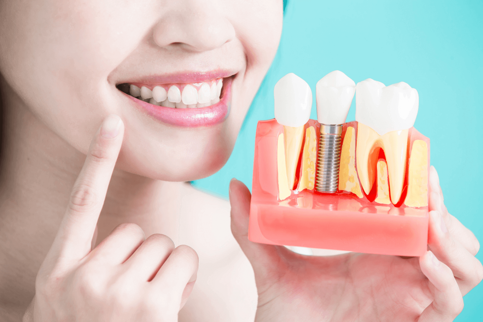 تجميل الأسنان الفرق او ما يعرف بالفلج حيث نجد ان هناك بعض الأشخاص