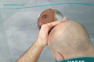 زراعة الشعر في مصر