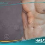 عمليات شد الجسم