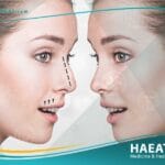 تجميل الانف الأرنبة