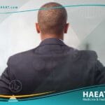 المنطقة المانحة في عملية زراعة الشعر