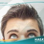 مظهرك بعد عملية زراعة الشعر