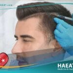 زراعة الشعر في إسطنبول