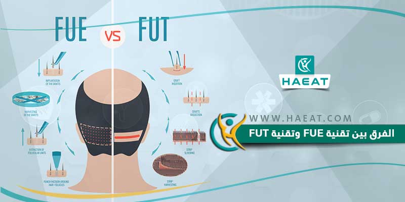 الفرق بين زراعة الشعر بتقنية FUE وتقنية FUT