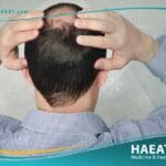 الصلع لدى الرجال، أسبابه وعلاجه