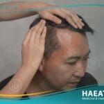 أسباب تساقط الشعر لدي الرجال