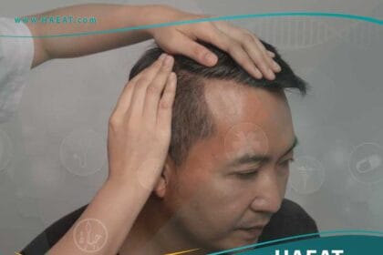 أسباب تساقط الشعر لدي الرجال