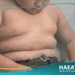 علاج السمنة عند الأطفال