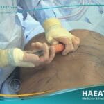 شفط الدهون وإعادة حقنها