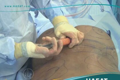 شفط الدهون وإعادة حقنها