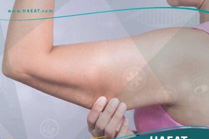 شفط الدهون من الذراعين