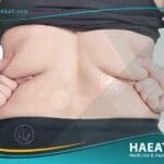 شفط الدهون من الظهر