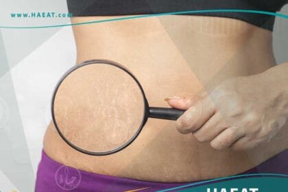 تجميل تشققات الجسم