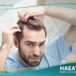 تساقط الشعر المزروع بعد العملية