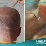 تقنية زراعة الشعر DHI