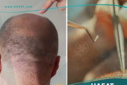 تقنية زراعة الشعر DHI