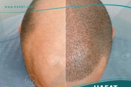 تقنية زراعة الشعر أقلام تشوي