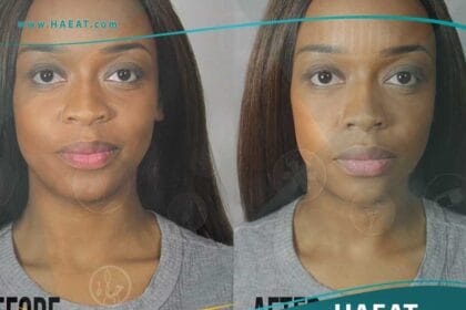 تجميل الانف الافطس