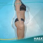 عملية شفط الدهون