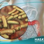 التهاب المعدة