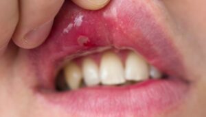 التهابات الفم والبلعوم واللوزتين