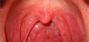 التهابات الفم والبلعوم واللوزتين
