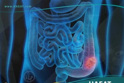 سرطان القولون