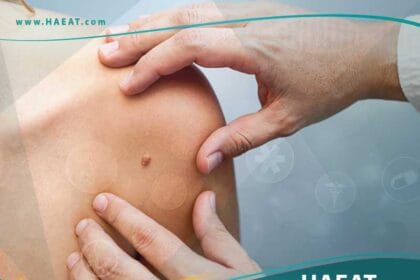 سرطان الجلد