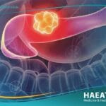 سرطان البنكرياس