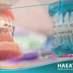 تقويم الاسنان