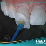 فينير الأسنان