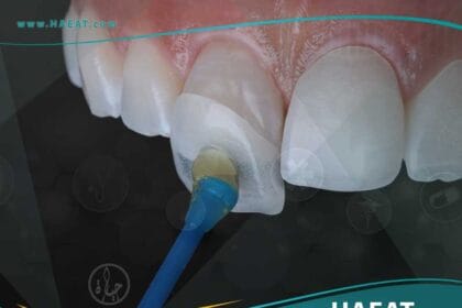 فينير الأسنان