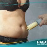 شفط الدهون وإعادة حقنها