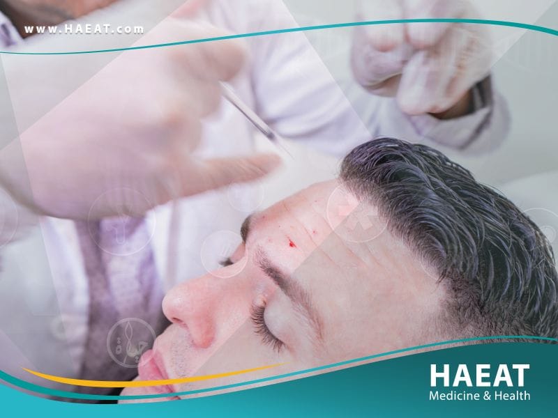 زراعة الشعر بتقنية الإقتطاف الدقيق Nano Fue | 5 مزايا 21 زراعة الشعر بتقنية الإقتطاف الدقيق