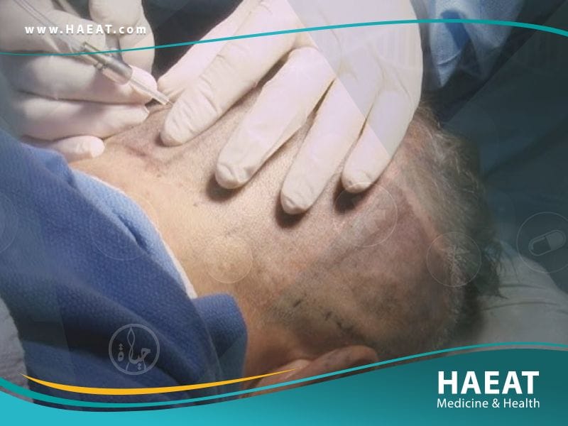 زراعة الشعر بتقنية الإقتطاف الدقيق Nano Fue | 5 مزايا 23 زراعة الشعر بتقنية الإقتطاف الدقيق