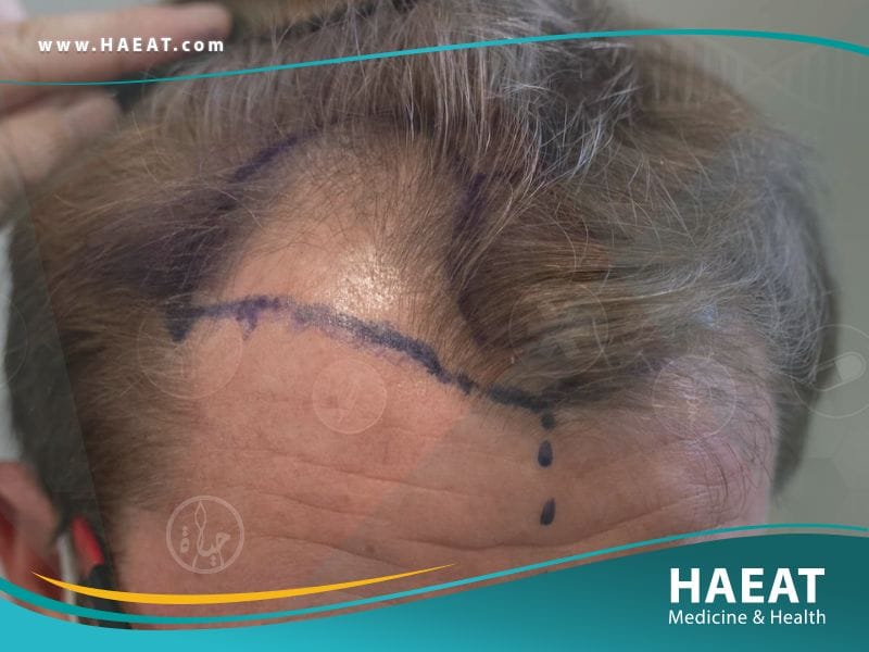 زراعة الشعر بتقنية الإقتطاف الدقيق Nano Fue | 5 مزايا 25 زراعة الشعر بتقنية الإقتطاف الدقيق