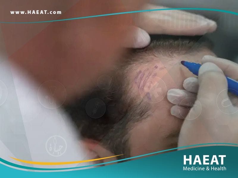 زراعة الشعر بتقنية الإقتطاف الدقيق Nano Fue | 5 مزايا 27 زراعة الشعر بتقنية الإقتطاف الدقيق