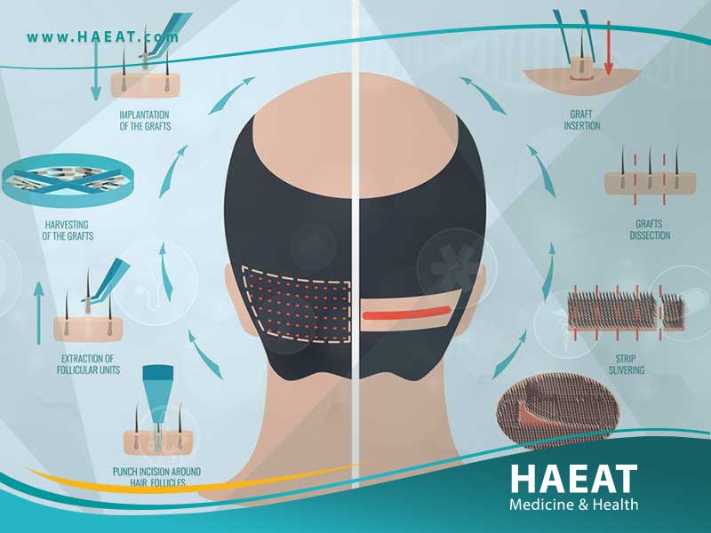 الفرق بين زراعة الشعر بتقنية DHI وتقنية البيركوتان