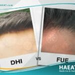 الفرق بين زراعة الشعر بتقنية FUE وتقنية أقلام تشوي
